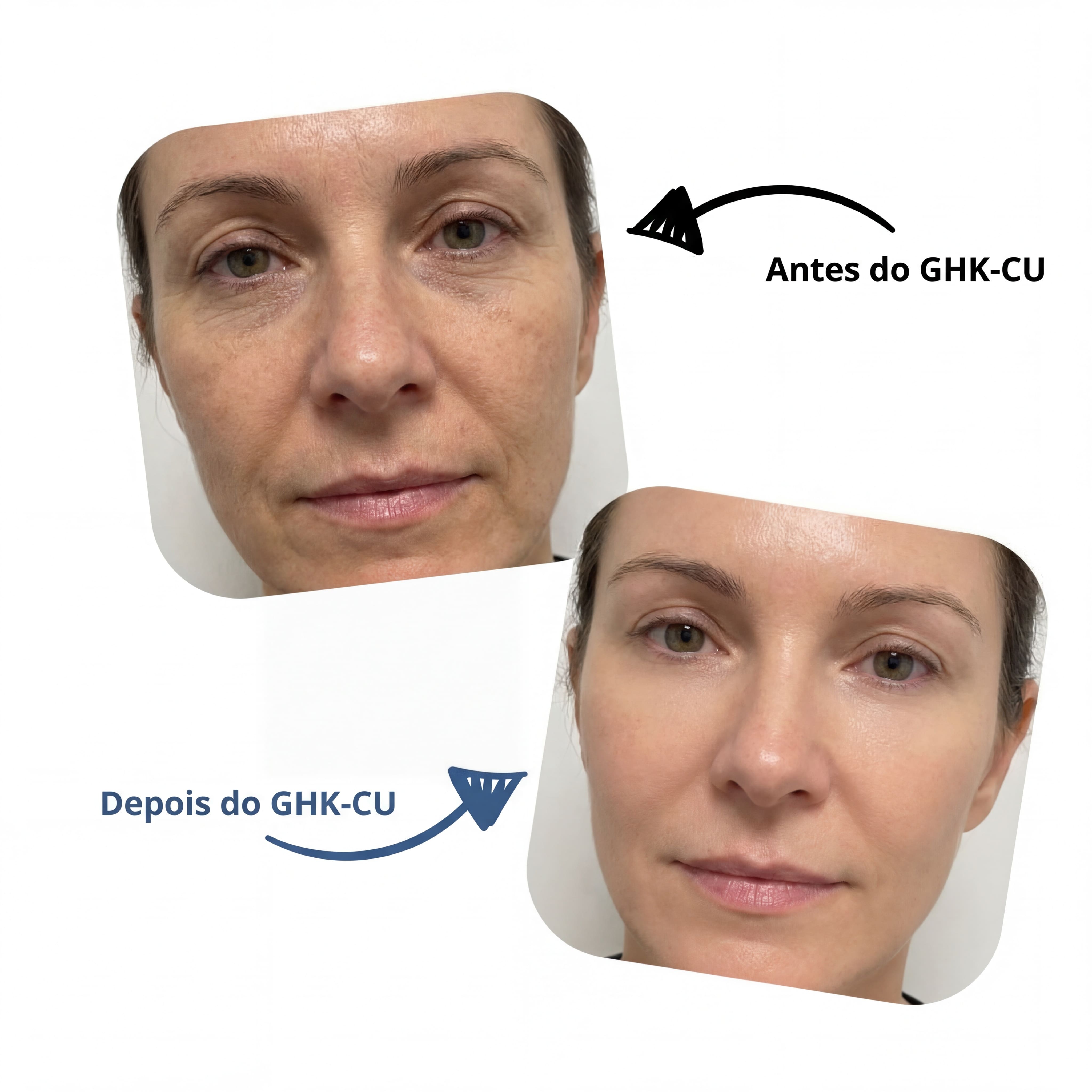Antes e Depois GHK-CU